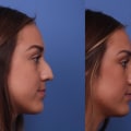 The Cost of a Nose Job: Is It Worth It?