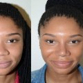The Truth About Rhinoplasty: An Expert's Perspective