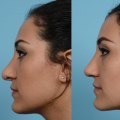 The Art of Rhinoplasty: A Surgeon's Perspective