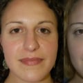 The Truth About Pain in Nose Jobs