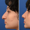 The Timeless Results of Rhinoplasty: Do Nose Jobs Age Well?