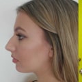 Affordable Nose Surgery: How to Get a Nose Job Without Breaking the Bank