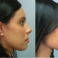 What You Need to Know About the Cost of a Nose Job