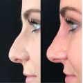 The Cost of Rhinoplasty: Why is it So Expensive in the US?