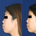 Does Rhinoplasty Last a Lifetime? An Expert's Perspective
