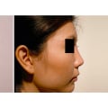 The Truth About Pain in Nose Surgery