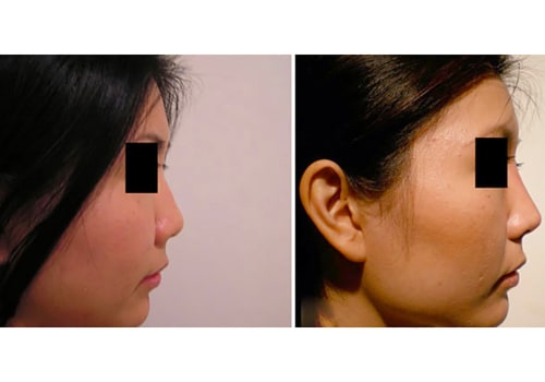 Is rhinoplasty considered major surgery?