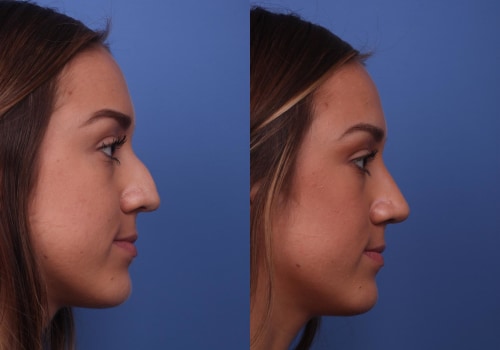 The Cost of a Nose Job: Is It Worth It?