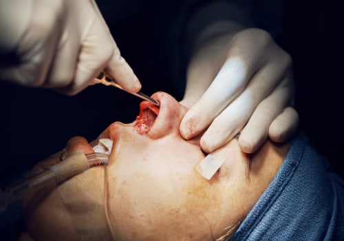 The Truth About Pain After a Nose Job