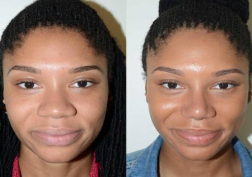 The Truth About Rhinoplasty: An Expert's Perspective