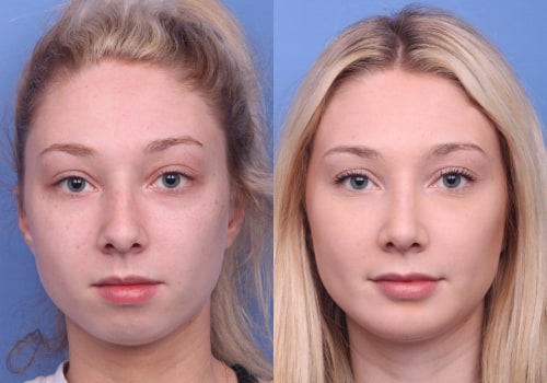 Does Rhinoplasty Last? An Expert's Guide to Long-Term Results