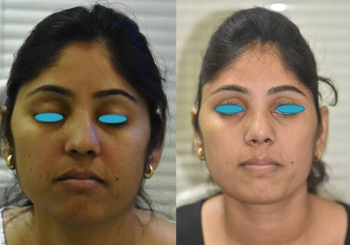 Why Rhinoplasties May Fail Years Later