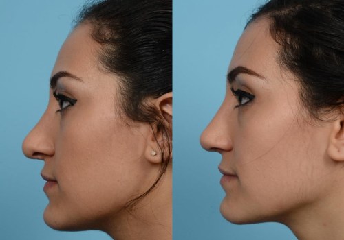 The Art of Rhinoplasty: A Surgeon's Perspective