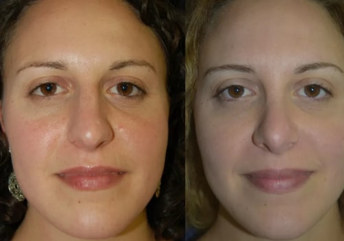 The Truth About Pain in Nose Jobs