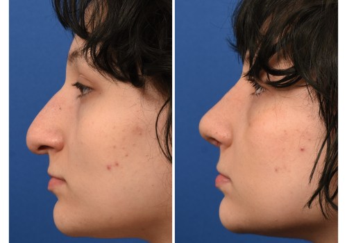 The Timeless Results of Rhinoplasty: Do Nose Jobs Age Well?