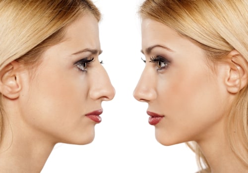 The Ins and Outs of Rhinoplasty Recovery