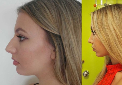 Affordable Nose Surgery: How to Get a Nose Job Without Breaking the Bank