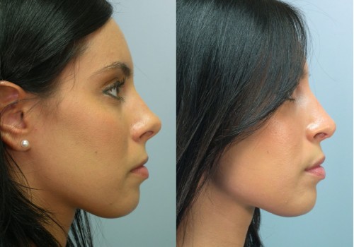 Is a Rhinoplasty a Major Operation?