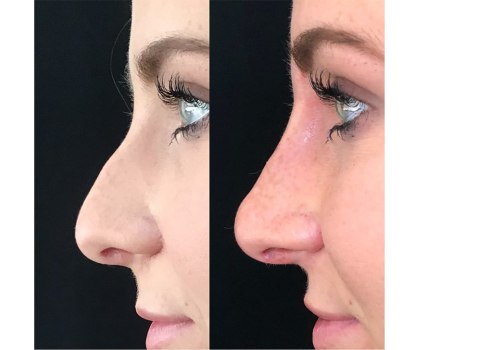The Cost of Rhinoplasty: Why is it So Expensive in the US?