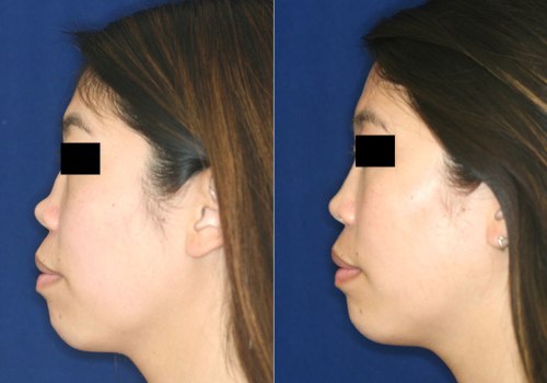 Does Rhinoplasty Last a Lifetime? An Expert's Perspective