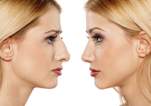 The Longevity of Rhinoplasty: How Long Will It Last?